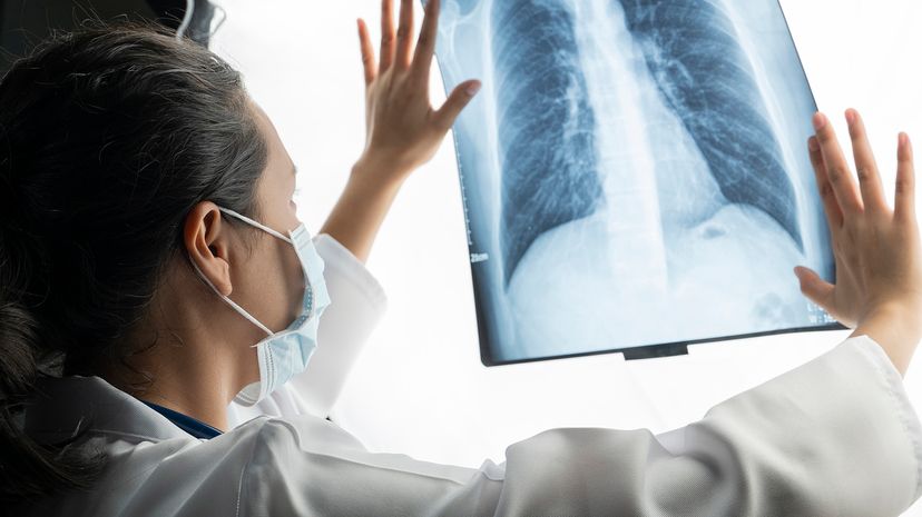A doctor speculates on X-ray images of a patient's lungs
