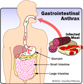 Gastrointestinal anthrax