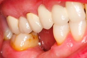 teeth affected by gingivitis