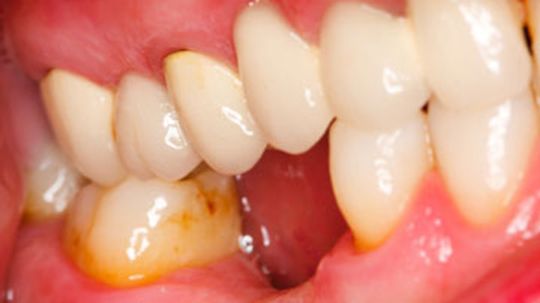 What is gingivitis?