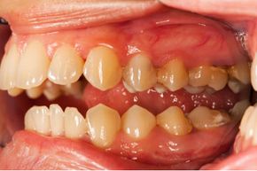 If you have gingivitis, your saliva contains bacteria that can be transferred to other people.