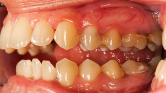 Is gingivitis contagious?