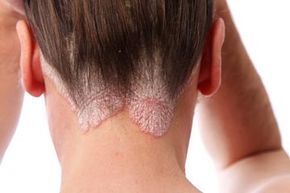 Psoriasis is just one possible cause of scalp sores. Do you know the rest?