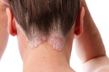 psoriasis