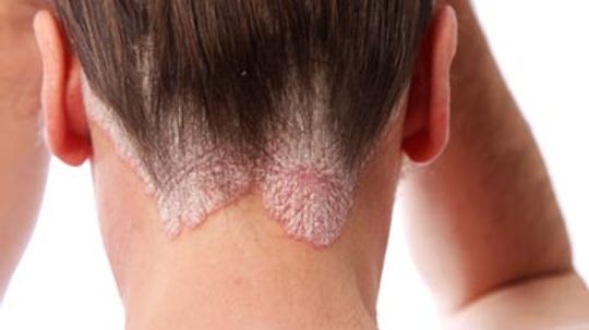 At a Glance: Scalp Sores