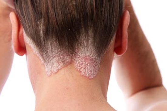 At a Glance: Scalp Sores