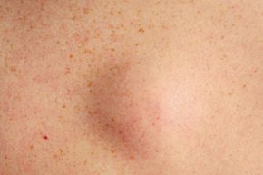 大多数脂肪沉积物在皮肤下以软块的形式出现。