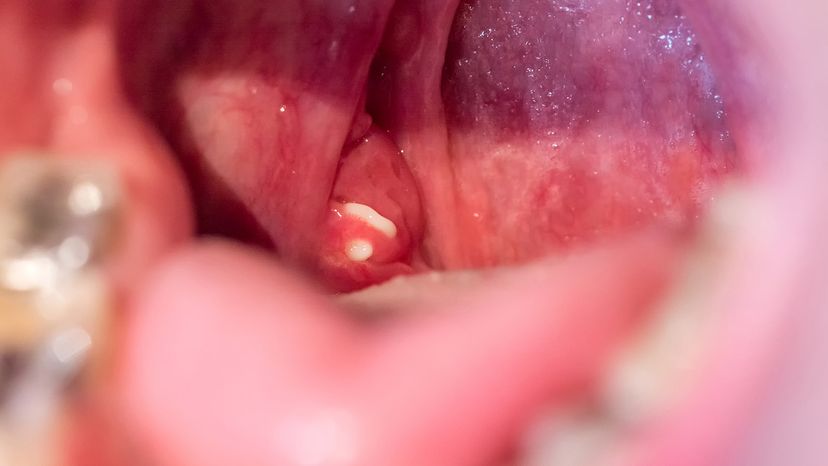 tonsil stones