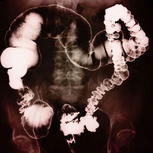 X-ray of colon