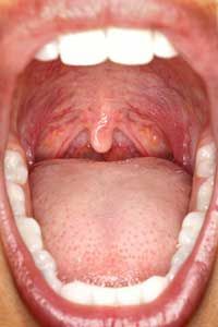 Halitosis is usually caused by bacteria produced inside our mouths.