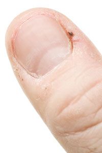 Sore hangnail on thumb.