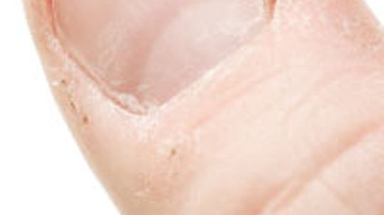 Hangnail Tips and Treatments