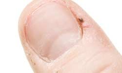 Don't tear your hangnail!