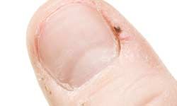 Sore hangnail on thumb.