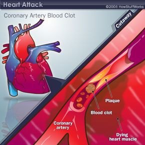 A heart attack, courtesy of a blood clot in a coronary artery