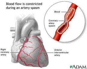 A coronary artery spasm can slow or stop blood flow through an artery.