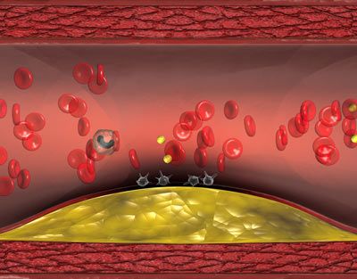 Coronary artery with atherosclerosis