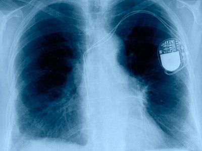 An artificial pacemaker.