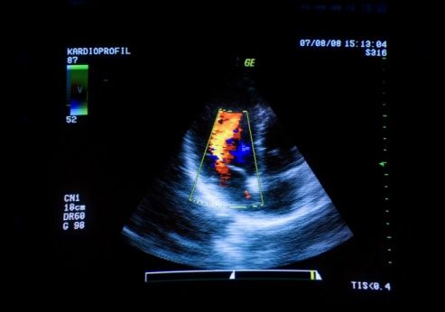 Heart ultrasound image