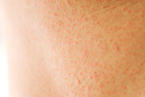 Macro shot of a skin rash.