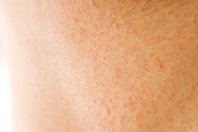 How Heat Rash Works