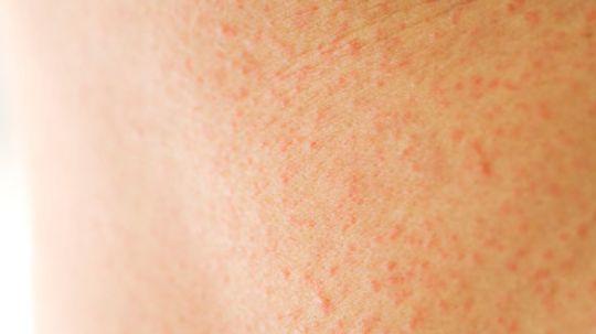 Heat Rash Overview