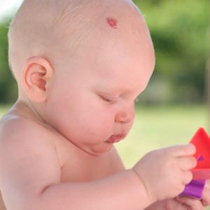 Baby with hemangiomas,also called a strawberry birthmark.