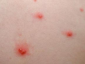 Chicken pox is a familiar sight to many of us. Luckily, it's not usually dangerous.