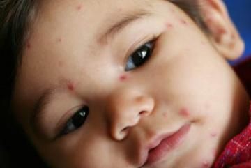 baby with chicken pox