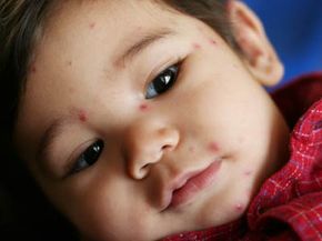 baby with chicken pox