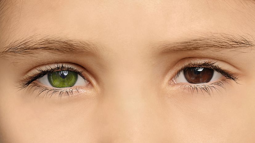 heterochromia iridum brown green