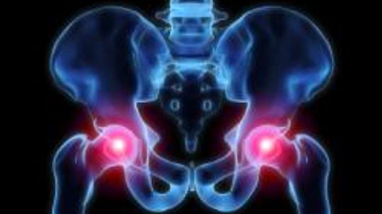 Hip Dysplasia Overview