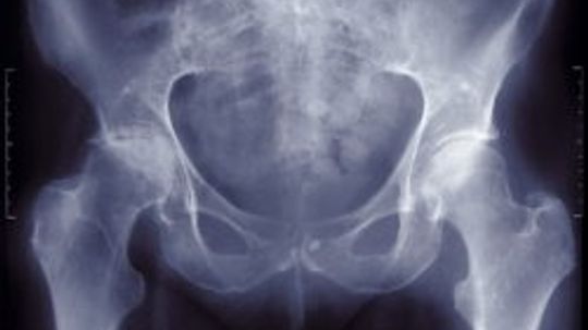 Osteoporosis Diagnosis and Risk Factors