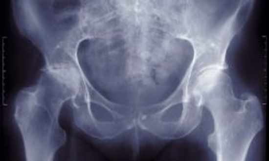 骨质疏松症诊断和风险因素”class=