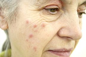 A woman has hives on her face.