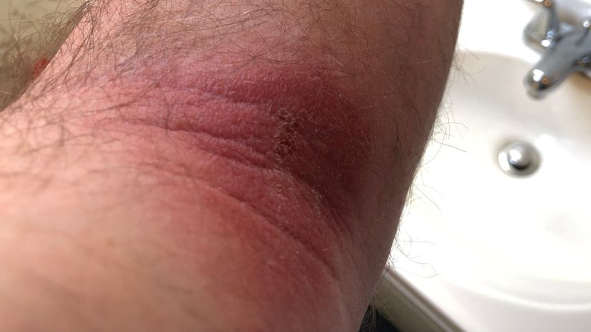 A poison ivy rash on a man's arm