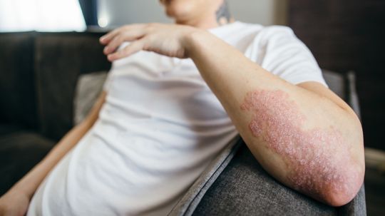 28 Home Remedies for Psoriasis