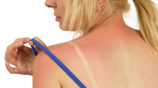 How to Prevent Sunburn