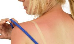 Girl with bad sunburn on her back and shoulders.