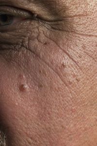 Beautiful Skin Image Gallery Moles are something you should keep an eye on. See more pictures of getting beautiful skin.