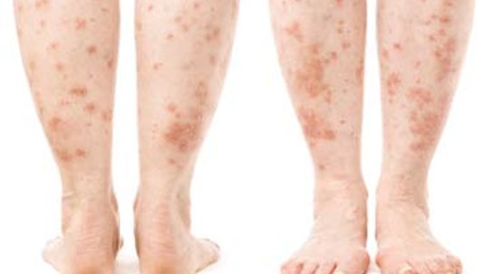 How long do skin allergy breakouts last?