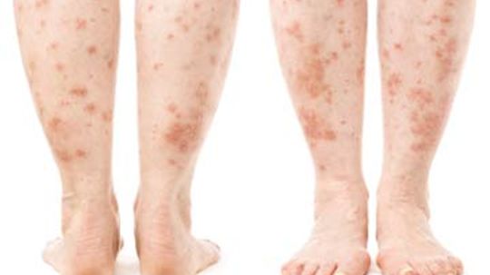 How to Identify a Skin Rash