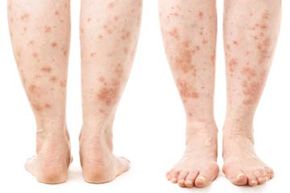 Woman with skin rash on back and front of lower legs.