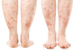 How to Identify a Skin Rash