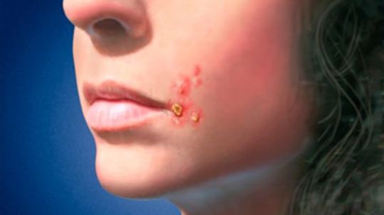 Impetigo Overview