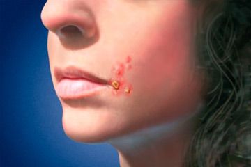 impetigo是由链球菌为化脓性链球菌引起的浅表皮肤感染。“border=