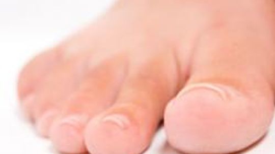 10 Home Remedies for Ingrown Toenails