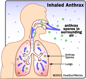 Inhaled anthrax