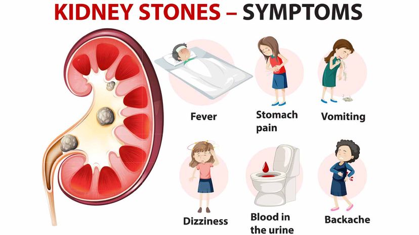 kidney stones