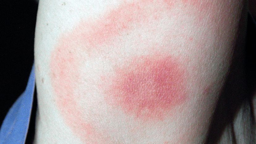 bullseye rash